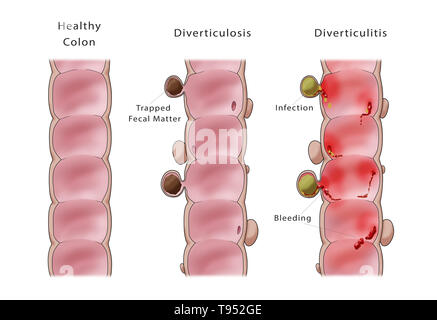 Illustrazione confrontando la diverticolosi (centrale) e diverticolite (a destra). Un sano colon è mostrato sulla sinistra. Foto Stock