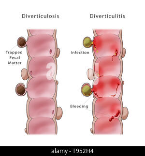 Immagine che mostra il confronto di un colon con la diverticolosi (sinistra) e diverticolite (a destra). Foto Stock