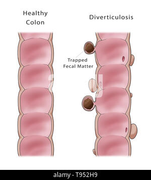 Illustrazione confrontando la comparsa di un sano colon (a destra) per uno con la diverticolosi (a destra). Foto Stock