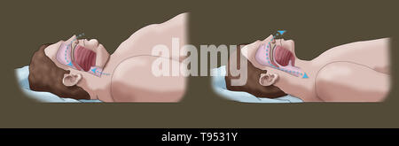 Una illustrazione di un confronto tra un obeso e traversina normale. Negli adulti, apnea nel sonno è comunemente causato da un eccesso di peso e l'obesità. Durante il sonno, quando la gola e la lingua i muscoli sono più rilassati, tessuti molli, eccesso di depositi di grasso e il peso di grasso addominale premendo sui polmoni possono interferire con il normale sonno. Foto Stock