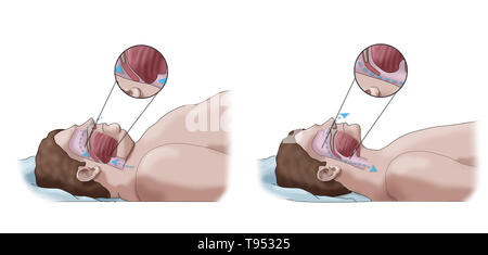 Una illustrazione di un confronto tra un obeso e traversina normale. Negli adulti, apnea nel sonno è comunemente causato da un eccesso di peso e l'obesità. Durante il sonno, quando la gola e la lingua i muscoli sono più rilassati, tessuti molli, eccesso di depositi di grasso e il peso di grasso addominale premendo sui polmoni possono interferire con il normale sonno. Foto Stock