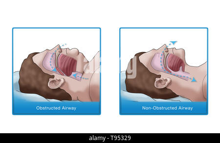 Una illustrazione di un confronto tra un obeso e traversina normale. Negli adulti, apnea nel sonno è comunemente causato da un eccesso di peso e l'obesità. Durante il sonno, quando la gola e la lingua i muscoli sono più rilassati, tessuti molli, eccesso di depositi di grasso e il peso di grasso addominale premendo sui polmoni possono interferire con il normale sonno. Foto Stock