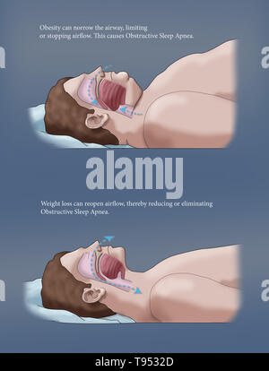 Una illustrazione di un confronto tra un obeso e traversina normale. Negli adulti, apnea nel sonno è comunemente causato da un eccesso di peso e l'obesità. Durante il sonno, quando la gola e la lingua i muscoli sono più rilassati, tessuti molli, eccesso di depositi di grasso e il peso di grasso addominale premendo sui polmoni possono interferire con il normale sonno. Foto Stock