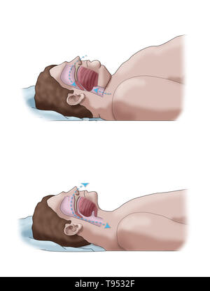 Una illustrazione di un confronto tra un obeso e traversina normale. Negli adulti, apnea nel sonno è comunemente causato da un eccesso di peso e l'obesità. Durante il sonno, quando la gola e la lingua i muscoli sono più rilassati, tessuti molli, eccesso di depositi di grasso e il peso di grasso addominale premendo sui polmoni possono interferire con il normale sonno. Foto Stock