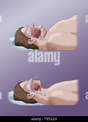 Una illustrazione di un confronto tra un obeso e traversina normale. Negli adulti, apnea nel sonno è comunemente causato da un eccesso di peso e l'obesità. Durante il sonno, quando la gola e la lingua i muscoli sono più rilassati, tessuti molli, eccesso di depositi di grasso e il peso di grasso addominale premendo sui polmoni possono interferire con il normale sonno. Foto Stock