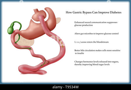 Roux-en-Y (RNY) il by-pass gastrico è una perdita di peso di un intervento chirurgico o chirurgia bariatrica, che viene eseguita su pazienti che hanno provato e fallito per perdere peso perdere utilizzando i metodi tradizionali. In Roux-en-Y il by-pass gastrico, un piccolo sacchetto nella parte superiore dello stomaco è la sola parte di esso che riceve cibo, limitando di aspirazione. Il piccolo intestino viene tagliato ad una breve distanza al di sotto dei principali dello stomaco e collegato alla nuova sacca. Alimento fluisce direttamente dalla tasca in questa parte dell'intestino. Foto Stock