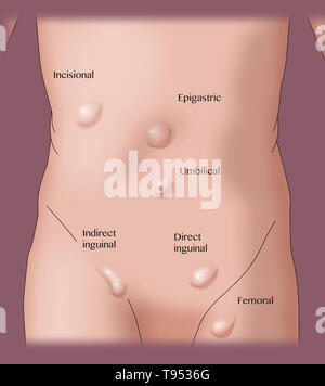 Una illustrazione che mostra i vari tipi di ernie. Foto Stock