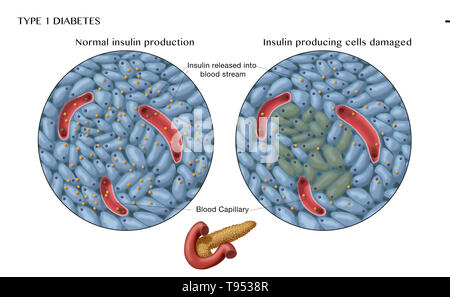 Una illustrazione che mostra il normale (sinistra) e danneggiato le cellule produttrici di insulina (destro) nel diabete di tipo 1. Foto Stock