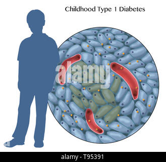 Una illustrazione che mostra danneggiato le cellule produttrici di insulina nel tipo 1 Il diabete infantile. Foto Stock