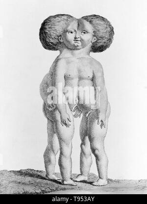 Gemelli siamesi, dal 1775. Incisi da Nicolas-Francois Regnault e intitolata 'Double bambino.". Foto Stock