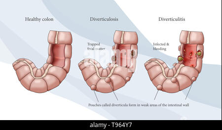 Illustrazione confrontando la comparsa di un sano colon (sinistra); diverticolosi (centrale); e diverticolite (a destra). Foto Stock