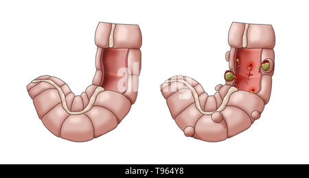 Illustrazione confrontando la comparsa di un sano colon (sinistra) e diverticolite (a destra). Foto Stock