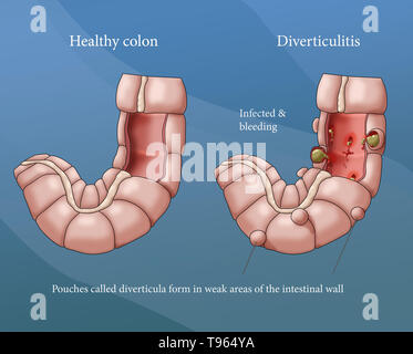 Illustrazione confrontando la comparsa di un sano colon (sinistra) e diverticolite (a destra). Foto Stock