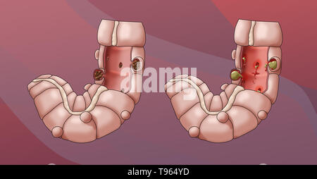 Illustrazione confrontando l'aspetto di un colon con la diverticolosi (sinistra) con diverticolite (a destra). Foto Stock