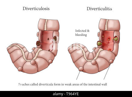 Illustrazione confrontando l'aspetto di un colon con la diverticolosi (sinistra) con diverticolite (a destra). Foto Stock