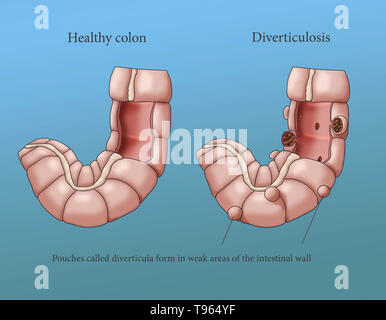 Illustrazione confrontando la comparsa di un sano colon (sinistra) per uno con la diverticolosi (a destra). Foto Stock