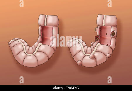 Illustrazione confrontando la comparsa di un sano colon (sinistra) per uno con la diverticolosi (a destra). Foto Stock