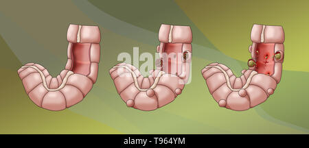 Illustrazione confrontando la comparsa di un sano colon (sinistra); diverticolosi (centrale); e diverticolite (a destra). Foto Stock