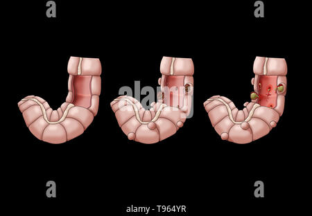 Illustrazione confrontando la comparsa di un sano colon (sinistra); diverticolosi (centrale); e diverticolite (a destra). Foto Stock