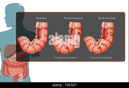 Illustrazione confrontando la comparsa di un sano colon (sinistra), diverticolosi (centrale), e diverticolite (destra); un maschio di silhouette con il sistema digestivo è evidenziata in background. Foto Stock