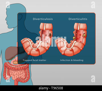 Illustrazione confrontando la comparsa di diverticolosi (sinistra) e diverticolite (destra); un maschio di silhouette con il sistema digestivo è evidenziata in background. Foto Stock