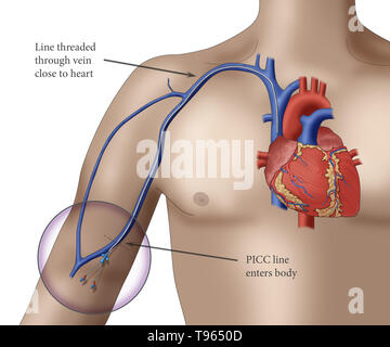 Illustrazione raffigurante un PICC (inserito perifericamente catetere centrale), un modulo di accesso per via endovenosa che può essere utilizzato per un periodo prolungato di tempo (come nei regimi di chemioterapia, per esempio). Foto Stock