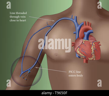 Illustrazione raffigurante un PICC (inserito perifericamente catetere centrale), un modulo di accesso per via endovenosa che può essere utilizzato per un periodo prolungato di tempo (come nei regimi di chemioterapia, per esempio). Foto Stock