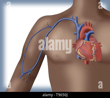 Illustrazione raffigurante un PICC (inserito perifericamente catetere centrale), un modulo di accesso per via endovenosa che può essere utilizzato per un periodo prolungato di tempo (come nei regimi di chemioterapia, per esempio). Foto Stock