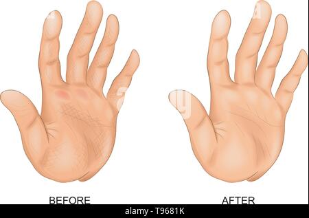 Illustrazione vettoriale della mano con la pelle ruvida e mano dopo i trattamenti termali Illustrazione Vettoriale