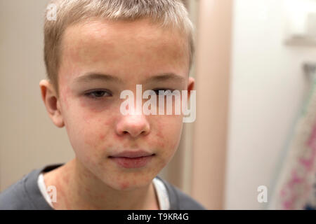 Ritratto di malati triste bambino affette da morbillo o varicella con dossi su tutta la faccia. Contagiosa malattie del bambino e il trattamento. Foto Stock
