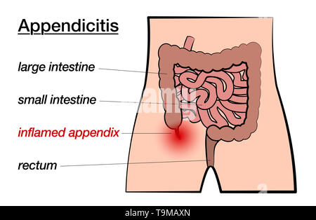 Appendicite. Appendice infiammata. Grafico marcato con il grande e il piccolo intestino, appendice e retto su sfondo bianco. Foto Stock