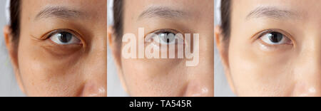 Tre immagini a confronto effetto prima e dopo il trattamento. sotto gli occhi con problemi di cerchi scuri ,il gonfiore e rughe periorbitale prima e dopo Foto Stock