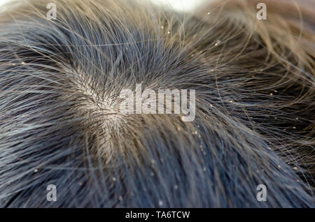 Uovo di pidocchio sui capelli provoca prurito testa. Foto Stock