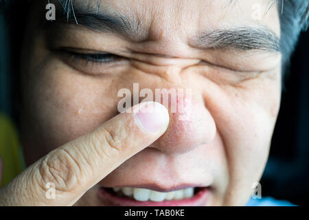 Asian guy tenendo il dito indice a grandi brufolo e blackhead brufoli e cicatrici da acne sul naso di lui Foto Stock