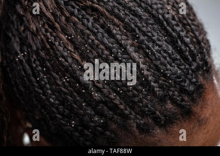 Close-up Photo Of Dandruff In Woman's Hair Foto Stock