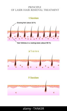 Vector illustarion che mostra il motivo per il quale è impossibile per rimuovere tutti i peli superflui in laser a una sessione di trattamento. In crescita e in appoggio dei follicoli piliferi Illustrazione Vettoriale