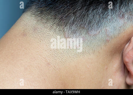 Chiuso di tigna (tinea) sulla testa di uomo asiatico (dermatiti) Foto Stock