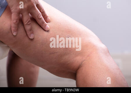 Una persona del ginocchio con vene varicose e capillari prima e dopo il trattamento medico Foto Stock