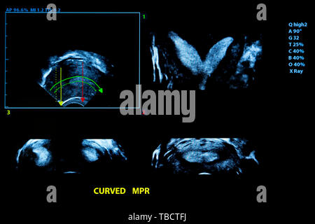 Immagine colorata dei moderni monitor ad ultrasuoni. Ecografia macchina. Alta tecnologia medica e attrezzature sanitarie. Imaging a ultrasuoni o sonogra Foto Stock