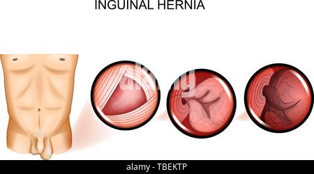 Illustrazione vettoriale di ernia inguinale intrappolamento. Intervento chirurgico Illustrazione Vettoriale