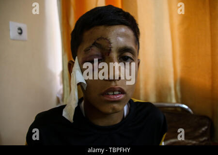 Beit Hanoun, Palestina. 2 giugno 2019 - 2 giugno 2019. Al Baraa Fayeq Ahmed al-Kafarneh, 11, riceve un trattamento medico in ospedale dopo essere stato ferito dai soldati israeliani sul confine venerdì proteste di Abu Safiya area nel nord della Striscia di Gaza. Â Il ragazzo ha perso il suo occhio immediatamente dopo essere stato colpito da un soldato israeliano con un proiettile di gomma e nonostante il trattamento ricevuto in un ospedale oftalmico di Gaza City. Secondo una relazione pubblicata dal 'Salva i bambini'' organizzazione alla fine dello scorso mese di marzo, a leastÂ 49Â i bambini hanno beenÂ ucciso a Gaza la recinzione di confine sin dall'inizio del GRE C Foto Stock