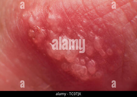 Inizio della coltivazione di herpes su caucasica uomo maschio sul lato anteriore di un labbro superiore super microscopio macro Foto Stock