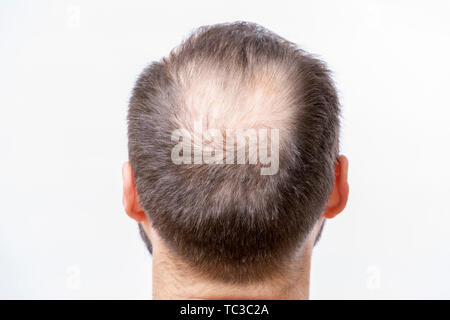 Uomo calvo ha un problema di testa calvizie e perdita dei capelli Foto Stock