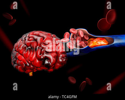 3d illustrazione di trombosi venosa profonda o coaguli di sangue. Embolia. Foto Stock