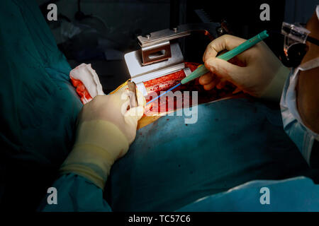 Strumenti chirurgici per la chirurgia a cuore aperto il processo di chirurgia cardiaca Foto Stock