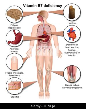 La vitamina B7 carenza medical illustrazione vettoriale isolati su sfondo bianco Una infografica Illustrazione Vettoriale