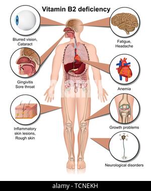 La vitamina B2 infografico carenza, 3d medical illustrazione vettoriale su sfondo bianco Illustrazione Vettoriale