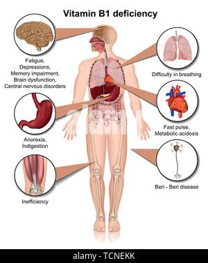 La vitamina B1 carenza 3d medical illustrazione vettoriale Una infografica su sfondo bianco di tiamina Illustrazione Vettoriale