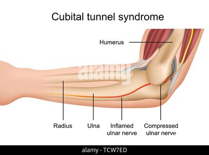 Cubital tunnel syndrome, infiammazione del nervo ulnare medical illustrazione vettoriale su sfondo bianco eps 10 Una infografica Illustrazione Vettoriale