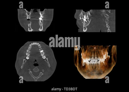 Serie di scanner MRI fette di parte dentale del maschio umano scull con problemi multipli su sfondo bianco. Foto Stock